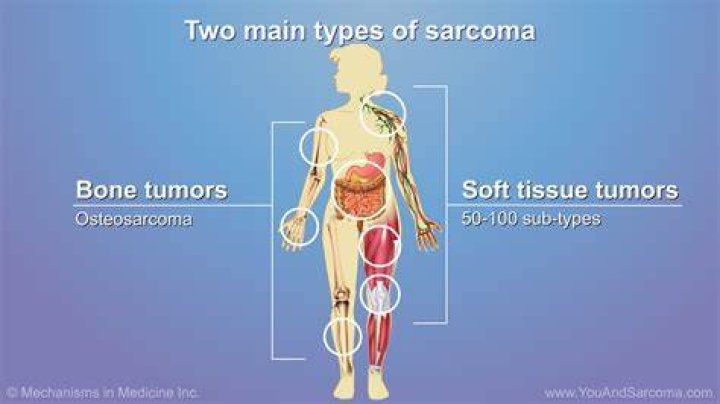 How does a sarcoma feel?
