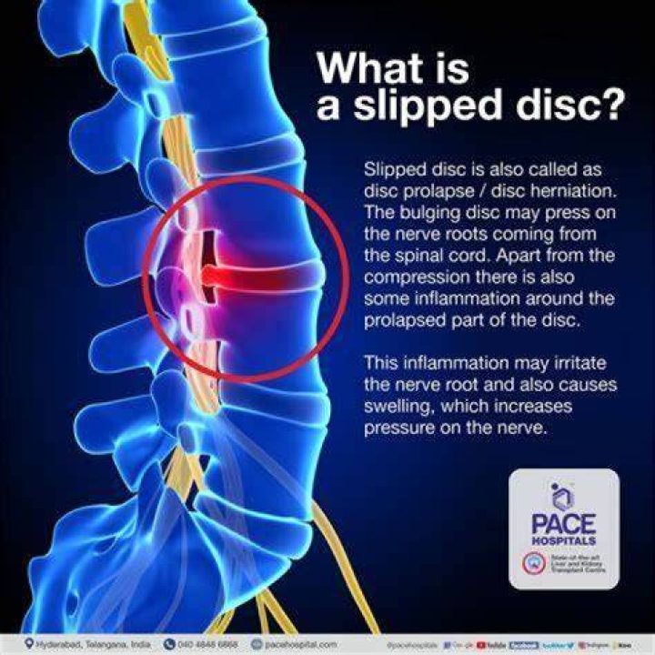 How does a slipped disc feel?