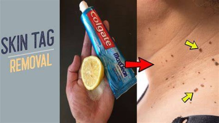 How does Colgate toothpaste remove skin tags?