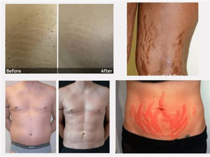 How does laser remove stretch marks?