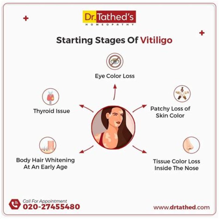 How does vitiligo start off?