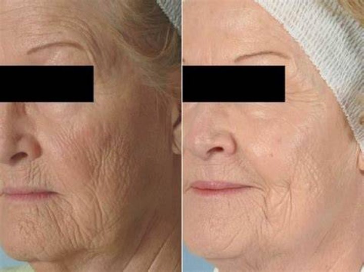How effective is microdermabrasion for wrinkles?
