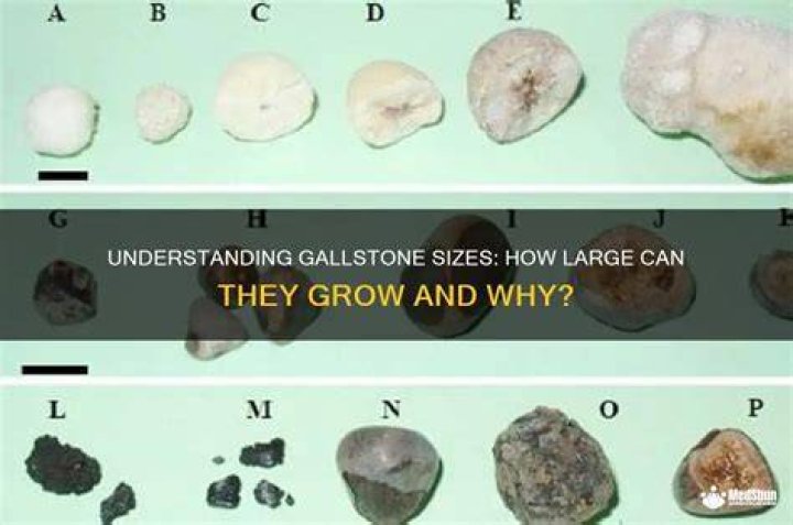 How fast do gallstones grow?