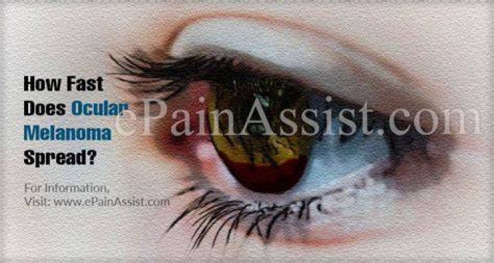 How fast does ocular melanoma spread?