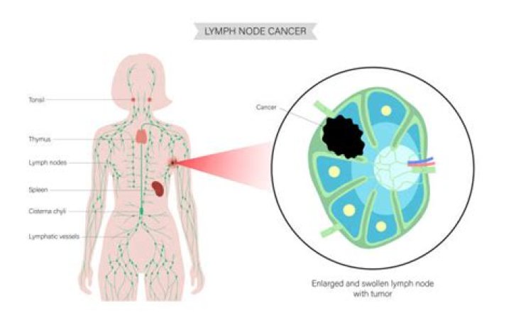 How hard is a cancerous lymph node?