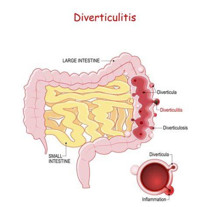 How long after diverticulitis can I have a colonoscopy?