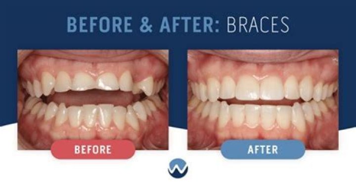 How long are teeth sore after braces tightened?