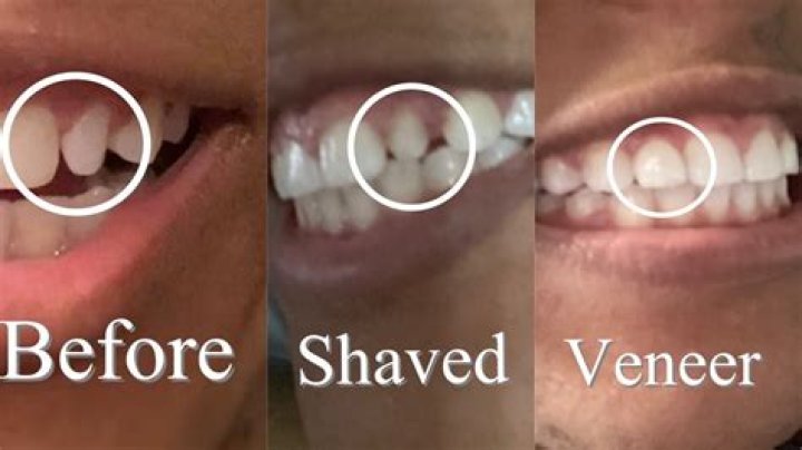 How long can you go without wearing retainers?