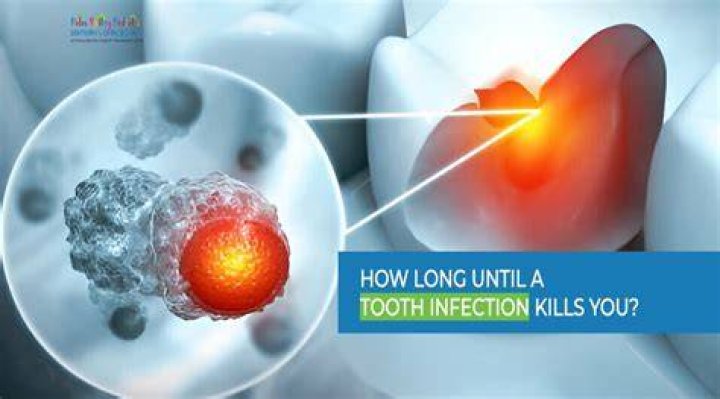 How long can you have a tooth infection before it kills you?