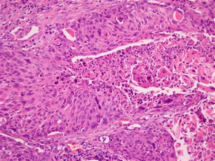 How long can you live with squamous cell carcinoma in lungs?