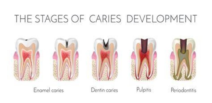 How long does it take a cavity to reach the nerve?