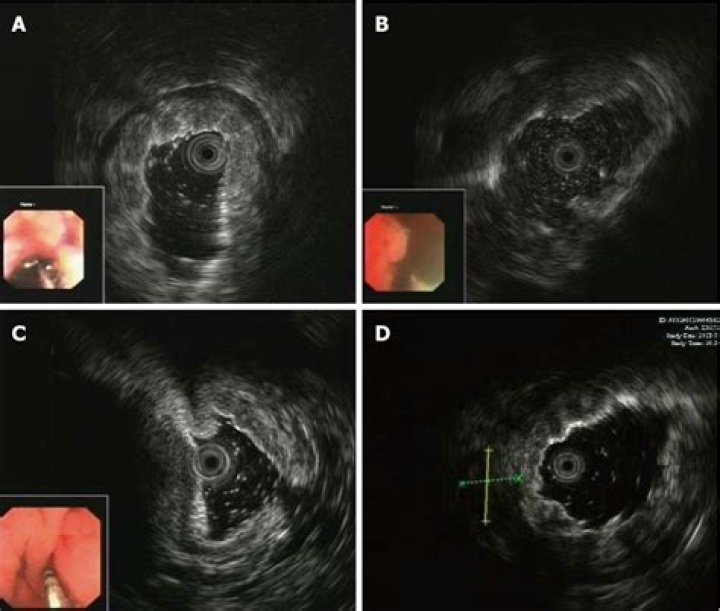 How long does it take to get results from an endoscopy biopsy?