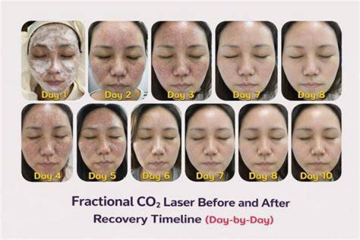 How long does it take to see Fraxel results?