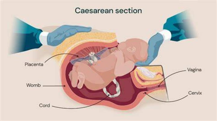 How many layers are stitched during C-section?