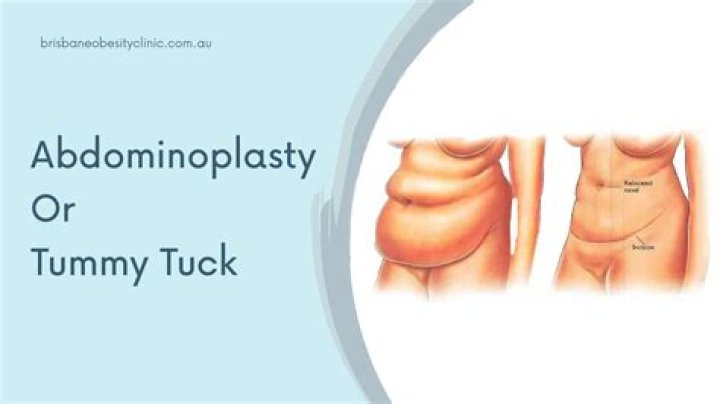 How many lbs Do you lose after a tummy tuck?