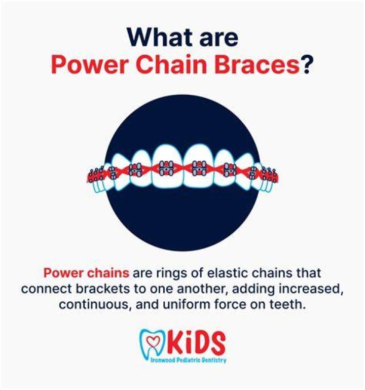 How much do power chain braces cost?