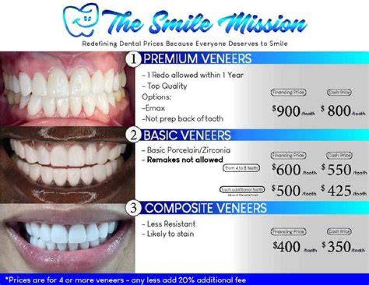 How much do the cheapest veneers cost?