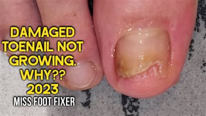 How much does it cost to get toenails removed?