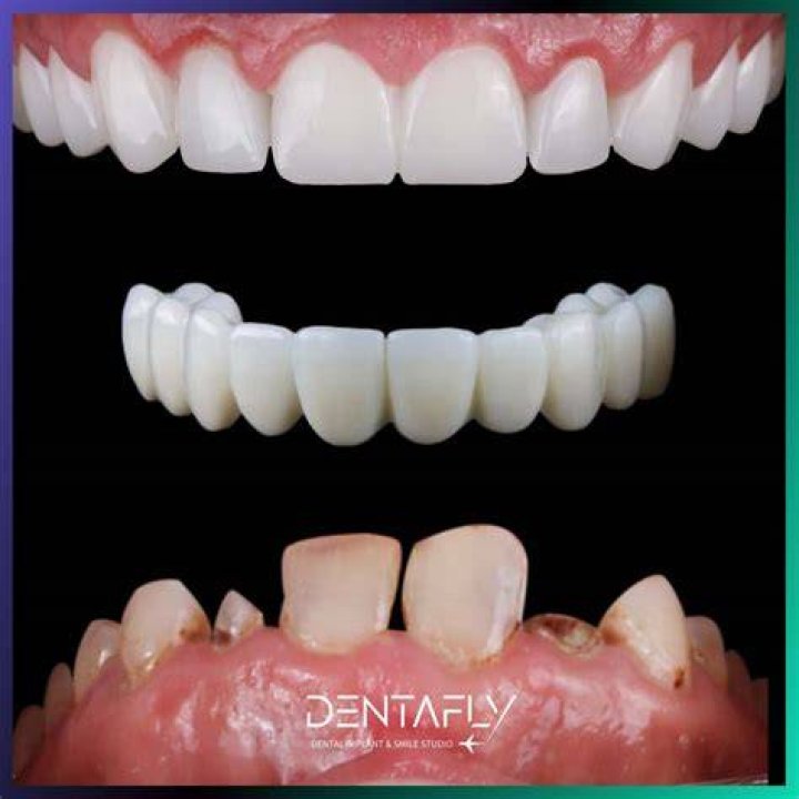 How much is a full set of teeth in Turkey?