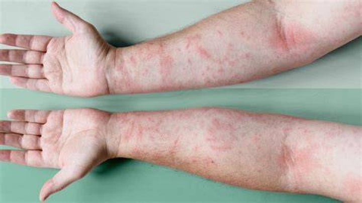 How much water clears up eczema?