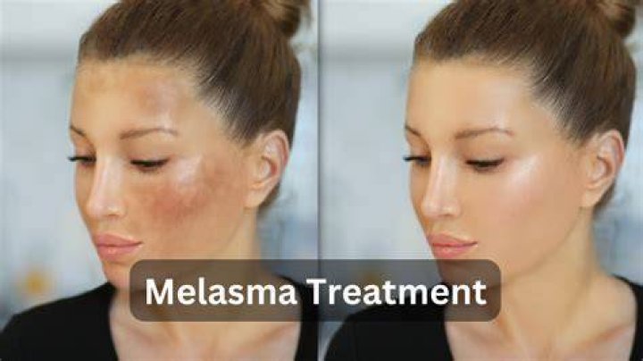 How often do dermatologists miss melanoma?