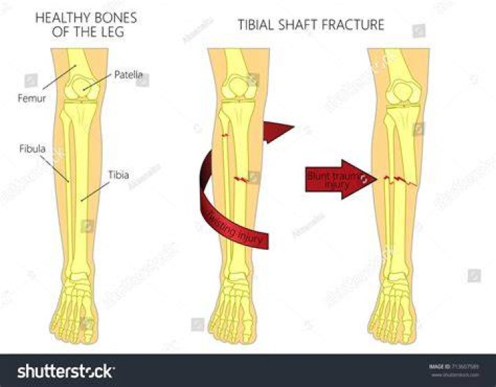 How painful is a broken tibia and fibula?