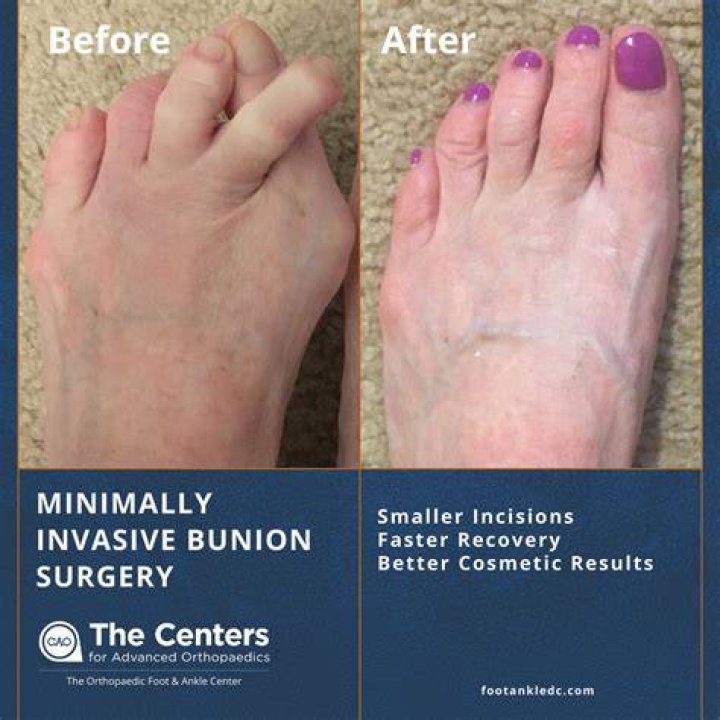 How soon can you put weight on your foot after bunion surgery?