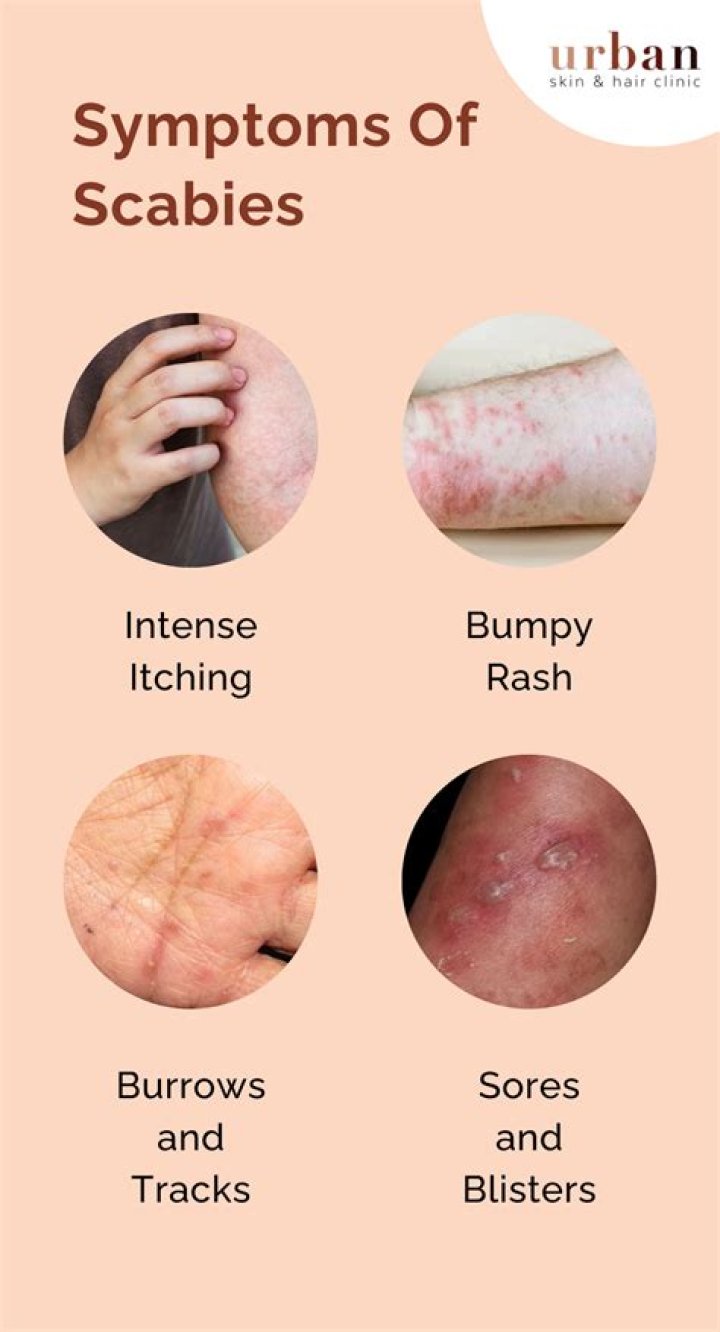 How will I know when my scabies are gone?