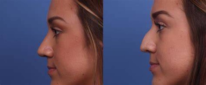 Is a nose job worth it?