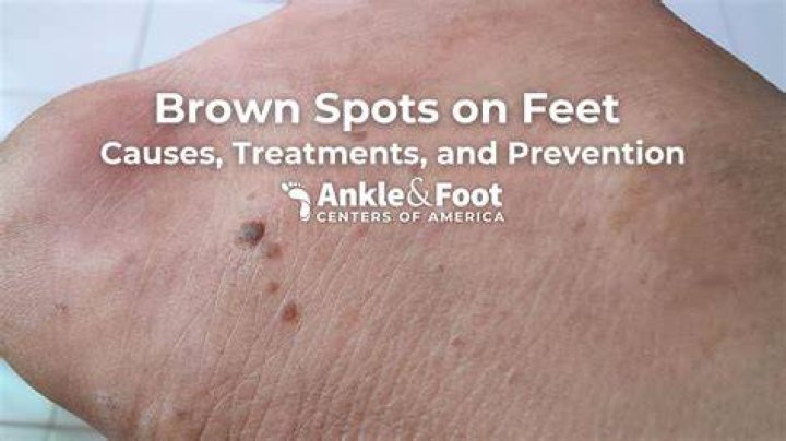 Is freckle on bottom of foot normal?