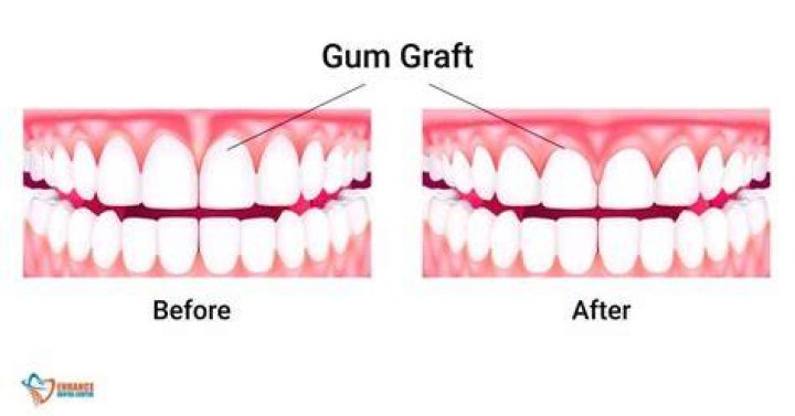 Is gum grafting permanent?