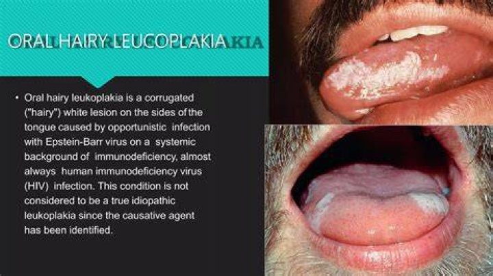 Is hairy leukoplakia benign?