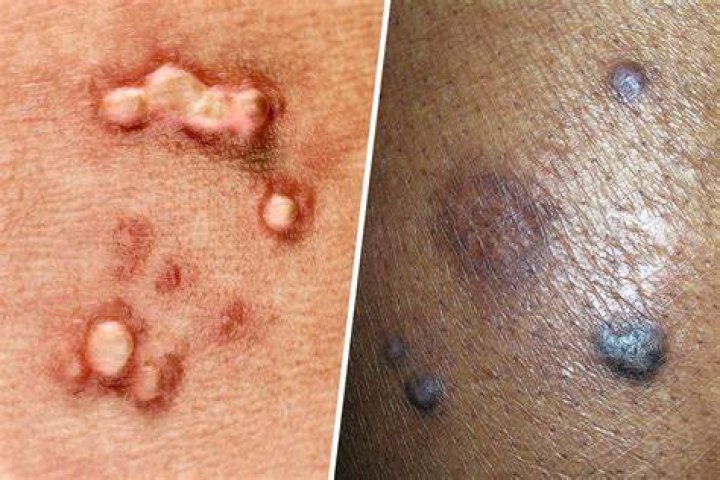 Is HPV still contagious after clear?