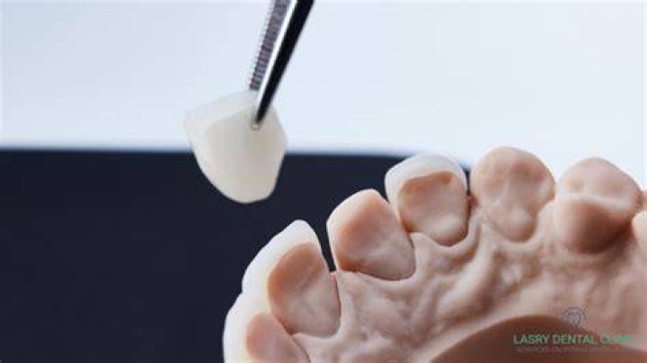 Is it easy to remove veneers?