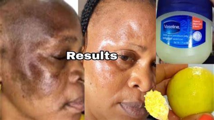 Is it OK to put lemon on face?