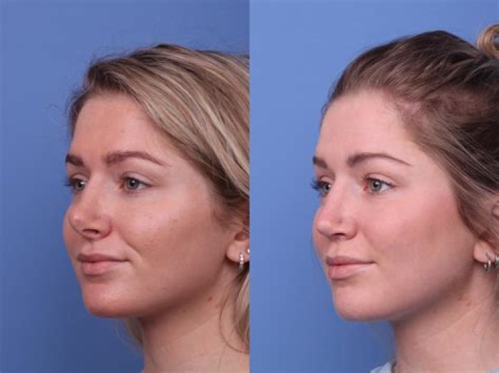 Is it painful to get a nose job?