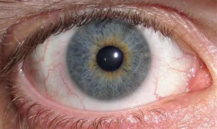 Is it rare to have gray eyes?