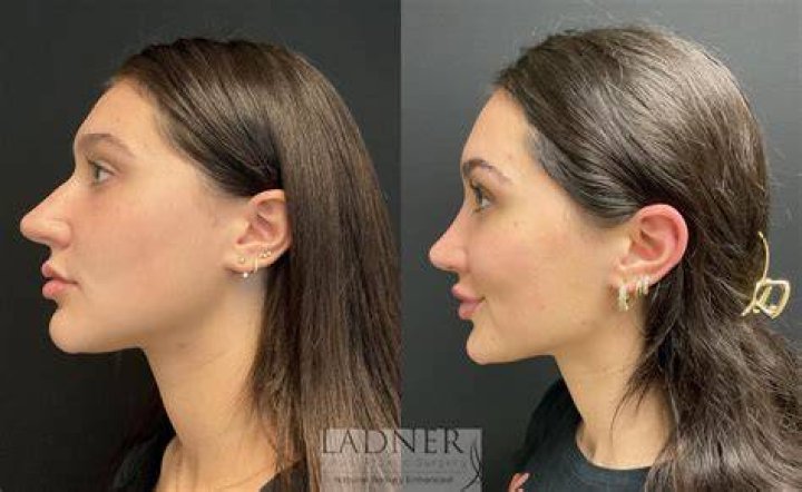 Is it weird to get a nose job?