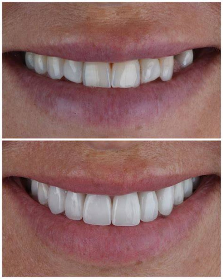 Is it worth it to get veneers?
