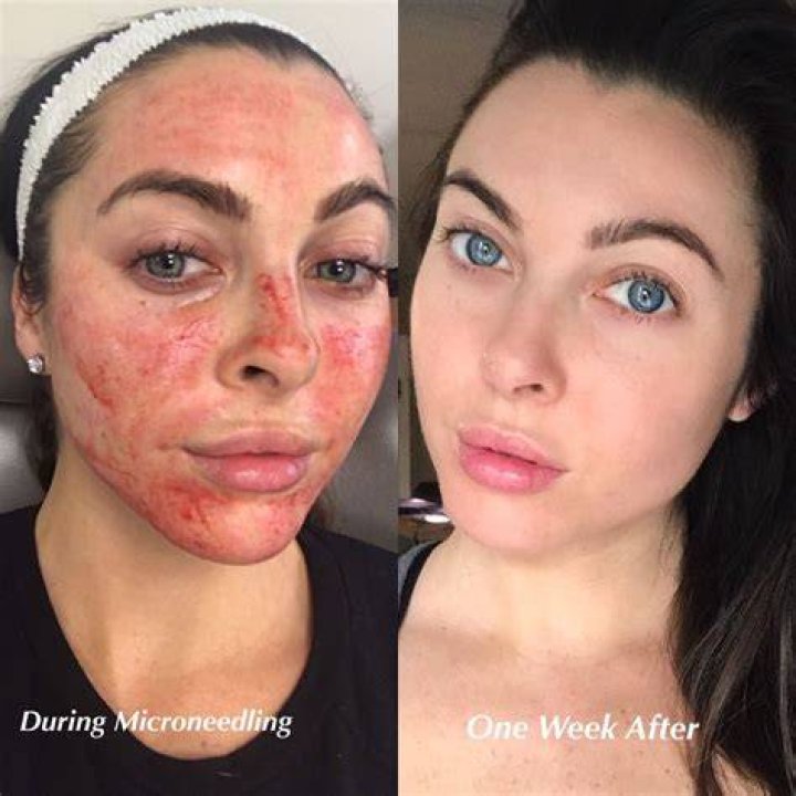 Is microneedling worth the cost?