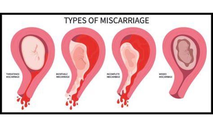 Is miscarriage considered infertility?