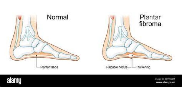 Is plantar fibroma the same as Ledderhose?