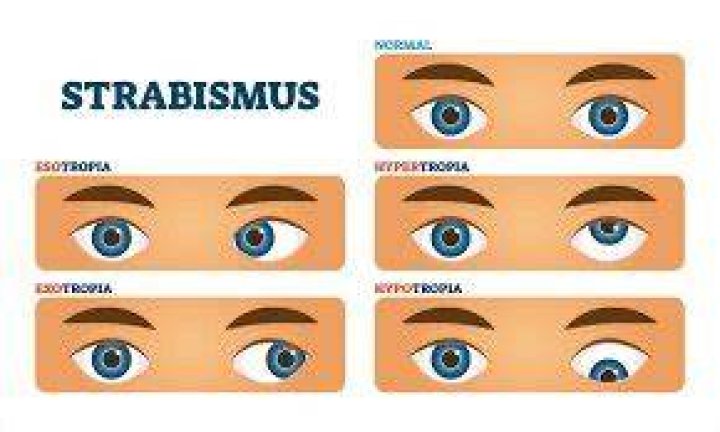 Is strabismus neurological?