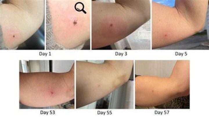 Should a tick bite hurt after removal?