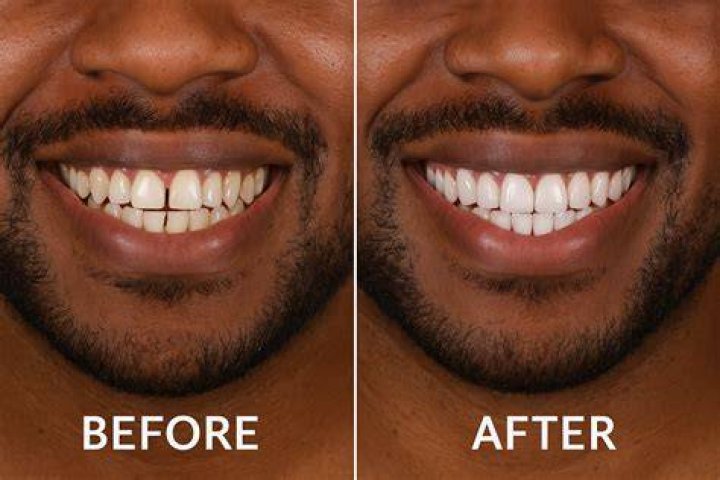 Should veneers be replaced over time?
