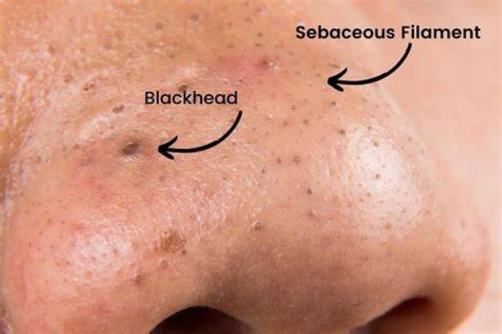 Should you push out blackheads?