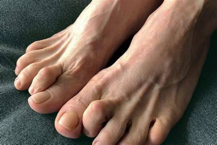 What are claw toes?