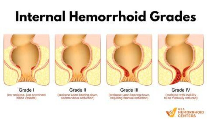 What are Stage 3 hemorrhoids?
