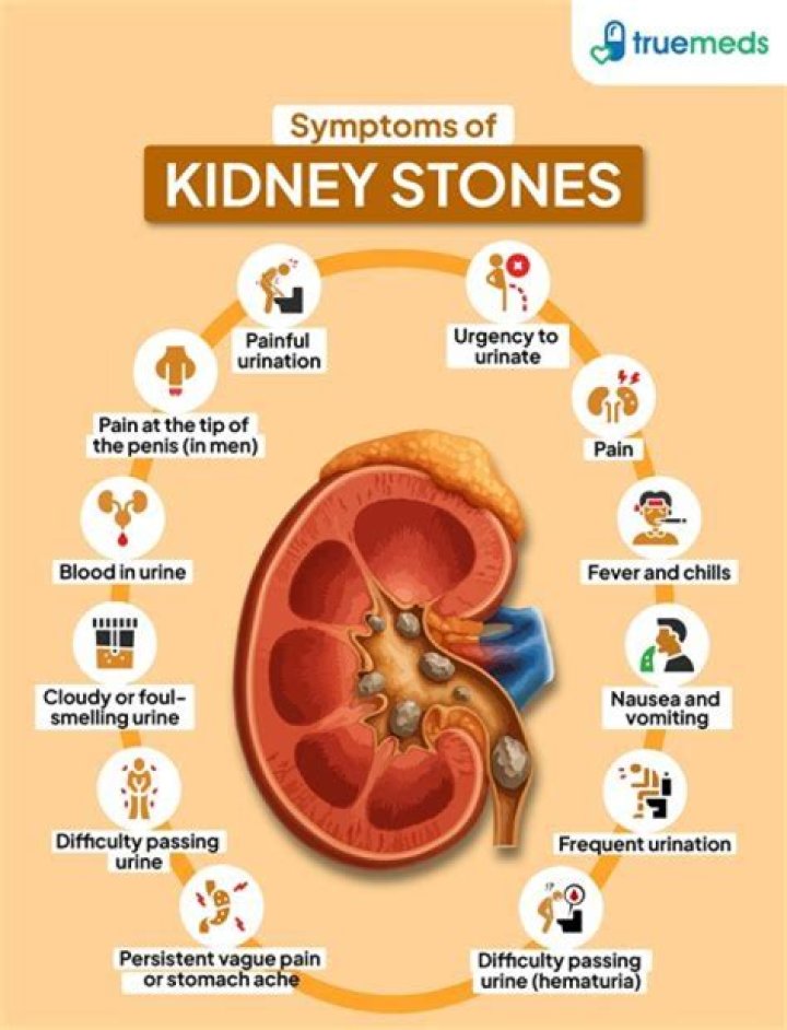 What are the first signs of passing a kidney stone?