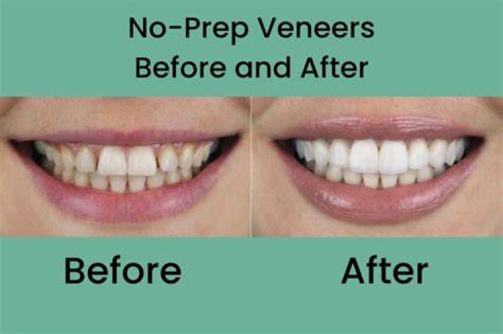 What are the problems with veneers?